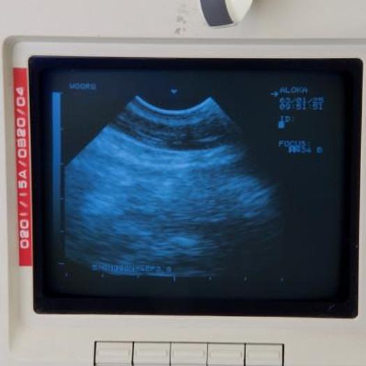 Used ALOKA SSD 500 PORTABLE ULTRASOUND SCANNER WITH ABDOMINAL PROBE AND ENDOVAGINAL PROBE