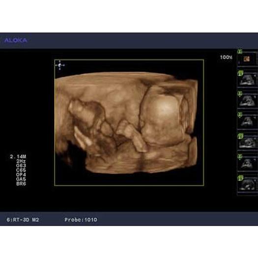ALOKA ALPHA 10 3D 4D RADIO ULTRASOUND SCANNER