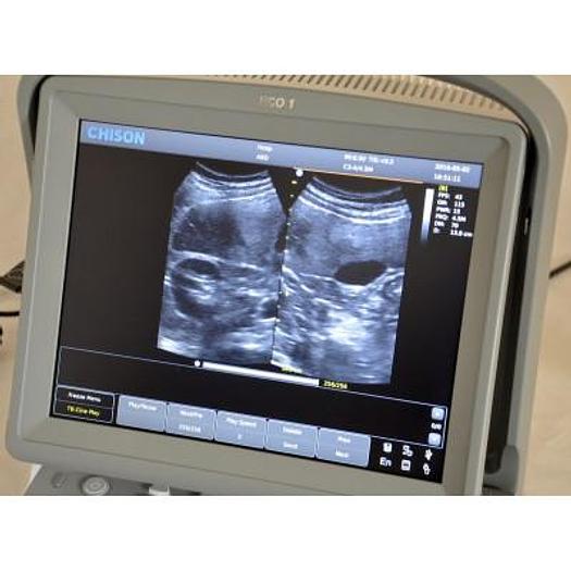 CHISON ECO1 PORTABLE ULTRASOUND WITH ABDOMINAL PROBE
