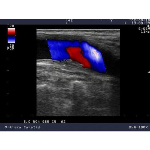 ALOKA PROSOUND 5500 COLOR DOPPLER DIGITAL ULTRASOUND SCANNER