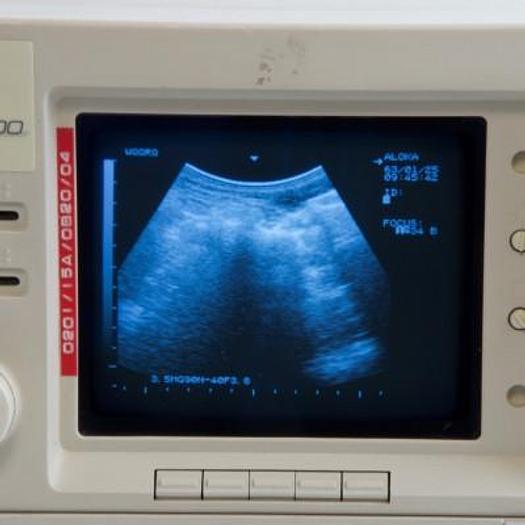 Used ALOKA SSD 500 PORTABLE ULTRASOUND SCANNER WITH ABDOMINAL PROBE AND ENDOVAGINAL PROBE