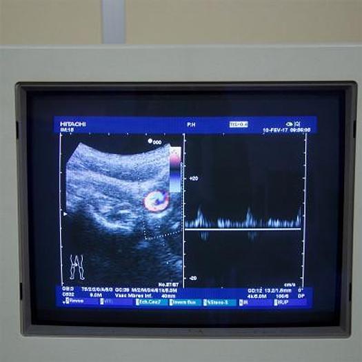Used ECHOGRAPHE DOPPLER COULEUR HITACHI PLATEFORME ELITE AVEC 3 SONDES